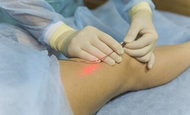 Veenilaiendite töötlemine laseriga