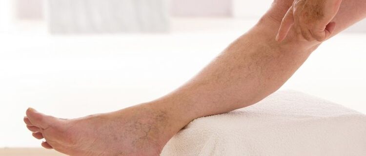 Veenilaiendid jalgadel